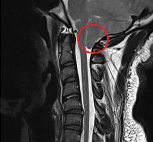 Chiari 1 without a complicated Syrinx