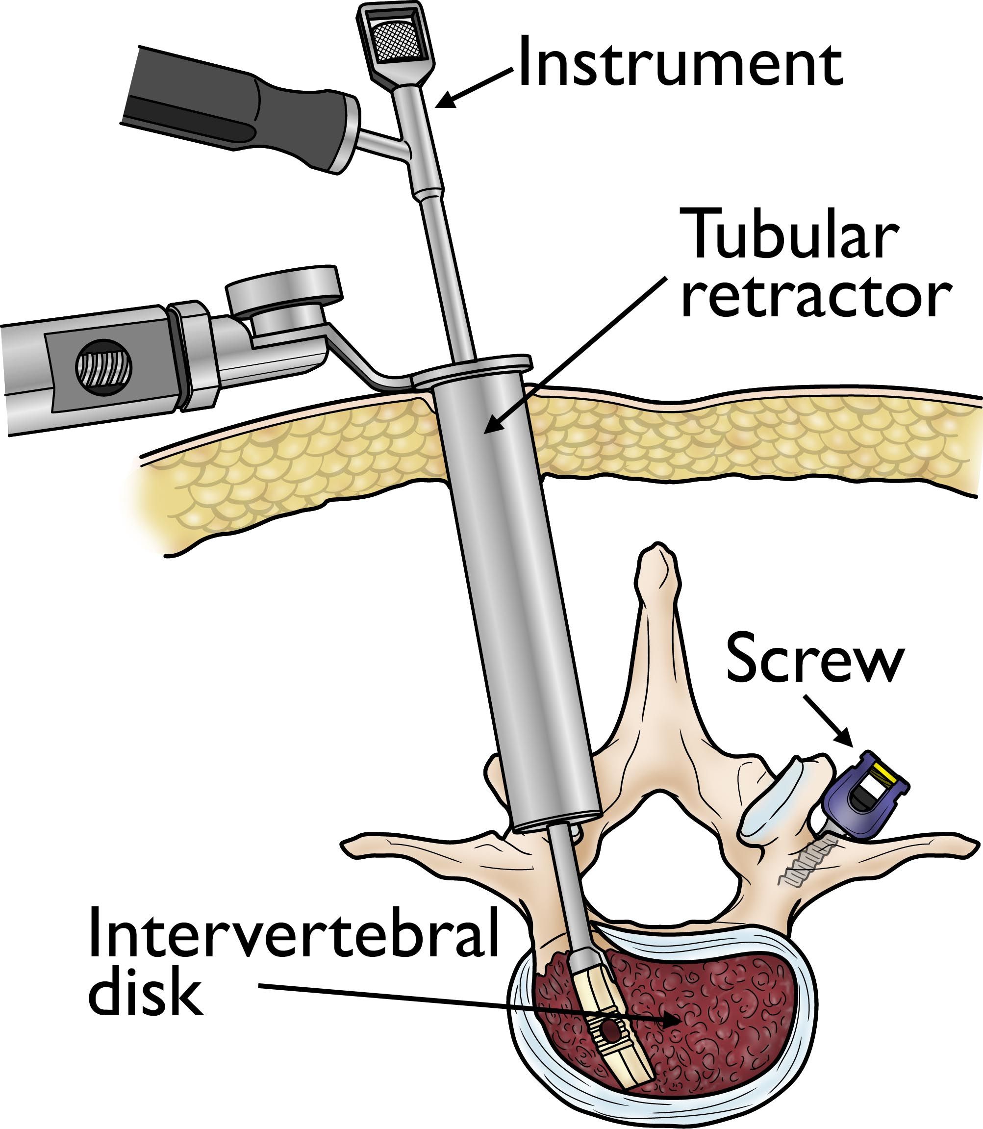 a00543f07-retractor_kh-compressor