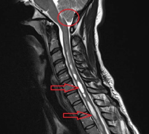 Chiari Malformation (CM)1 – Haider Kareem